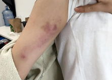 胳膊受伤图片,康复之路与生活挑战